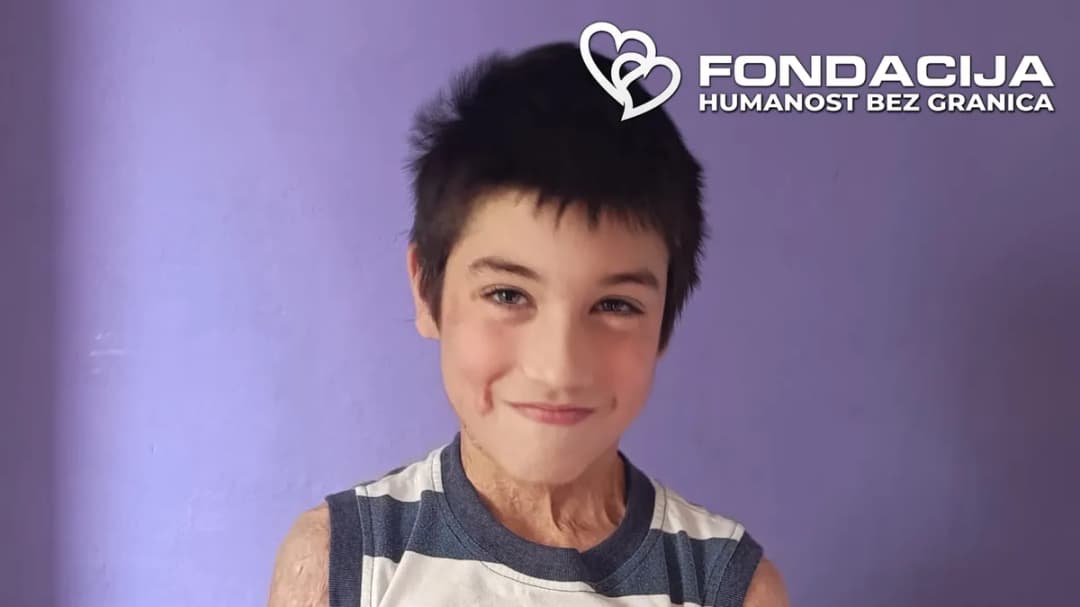 Slika uz članak: Nikolu je majka polila kiselinom, a potom je s njim skočila s trećeg sprata: Uspeo je da preživi, ali mu je potrebna naša pomoć