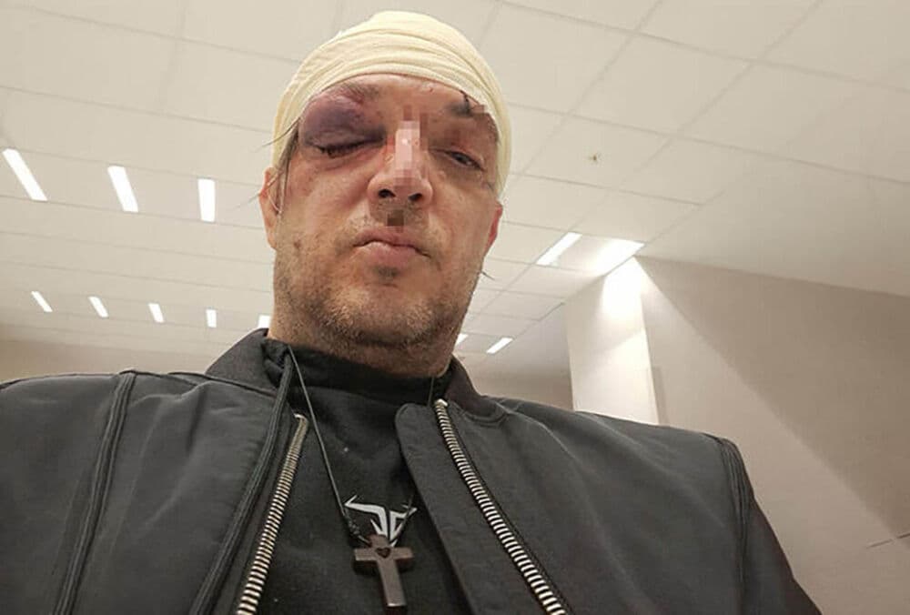 Slika uz članak: Zoran Marjanović izubijan, jeziva slika: Tukao ga pištoljem po glavi u pola noći
